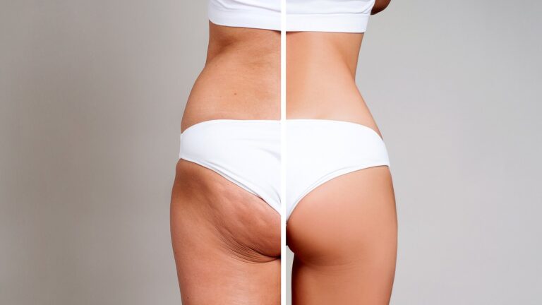 5 Healthy Ways to Remove or Reduce Your Cellulite