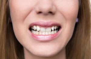 Straightening Crooked Teeth: Insights from a London Cosmetic Dentist