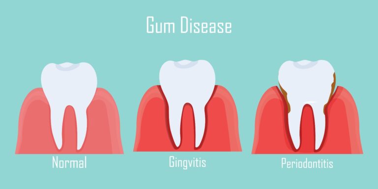 Bleeding Gums? It’s Not “Normal” and This Is What It Means